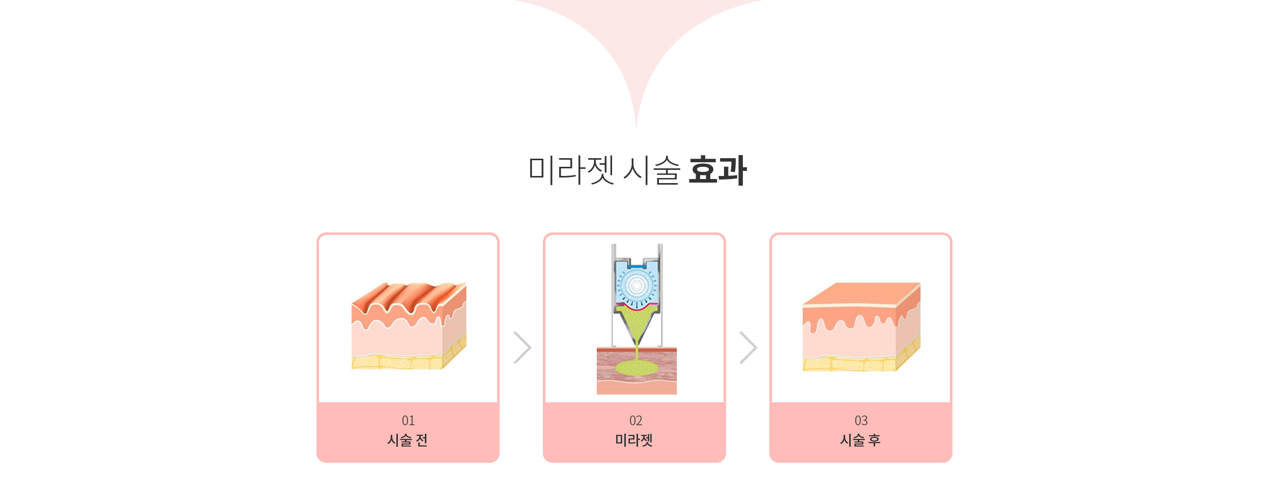 미라젯 시술 효과