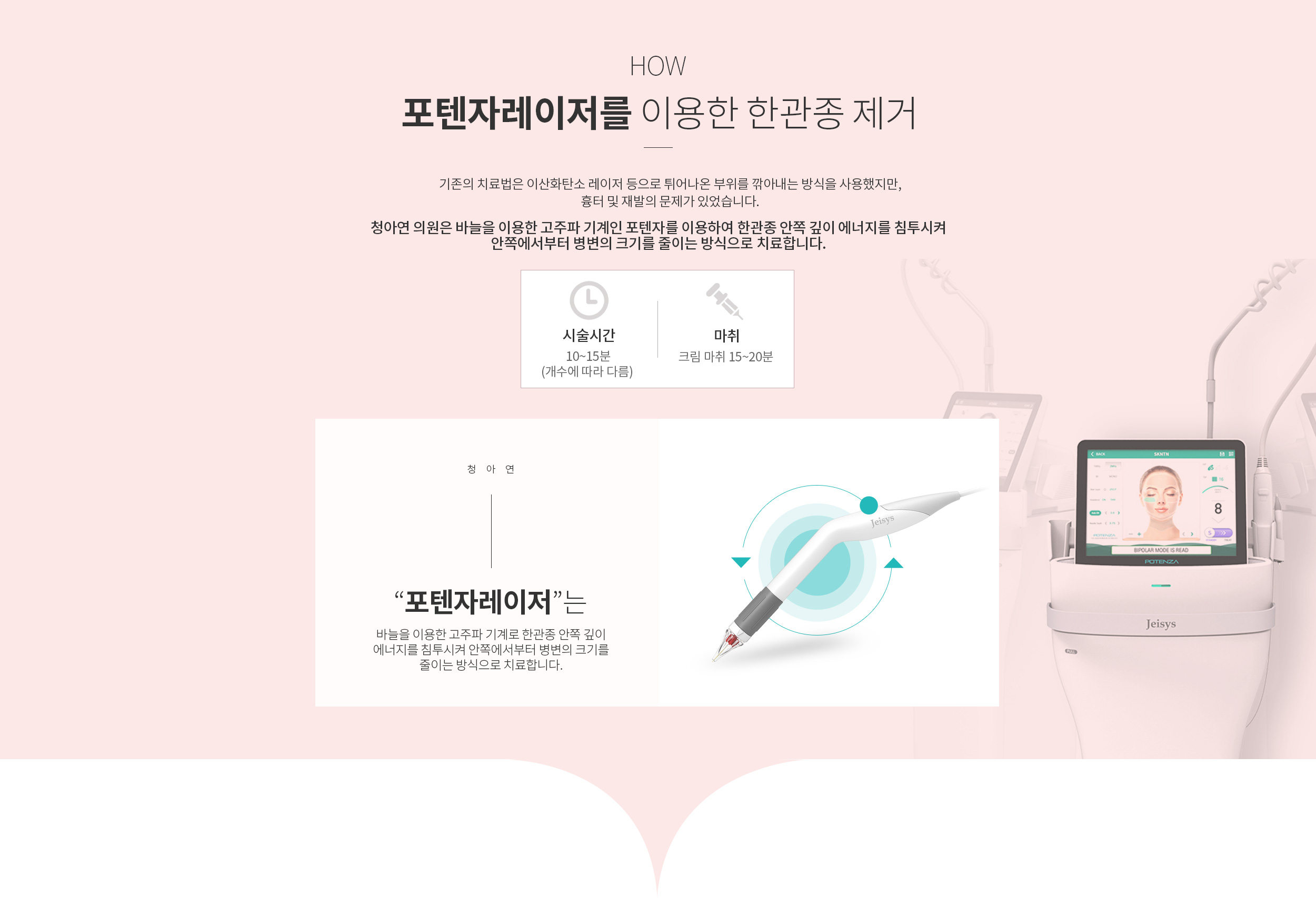 포텐자레이저를 이용한 한관종 제거