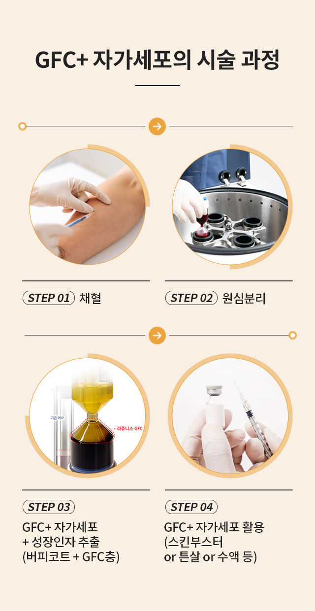 줄기세포 시술 과정