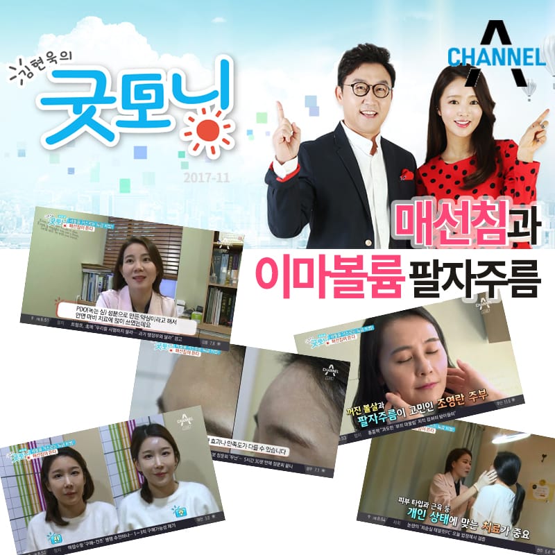 매선침 관련 김현욱의 굿모닝 방송출연분 안내 / 2017