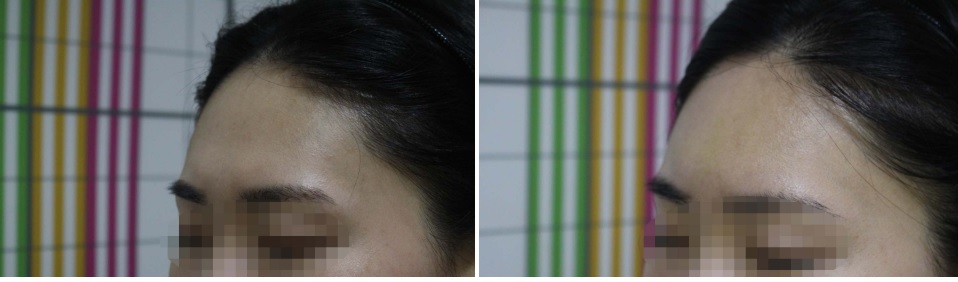 이마 매선 꺼진이마 이마꺼짐.jpg